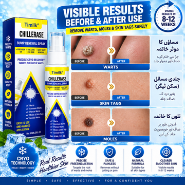Timilk Wart & Mole Removal Spray