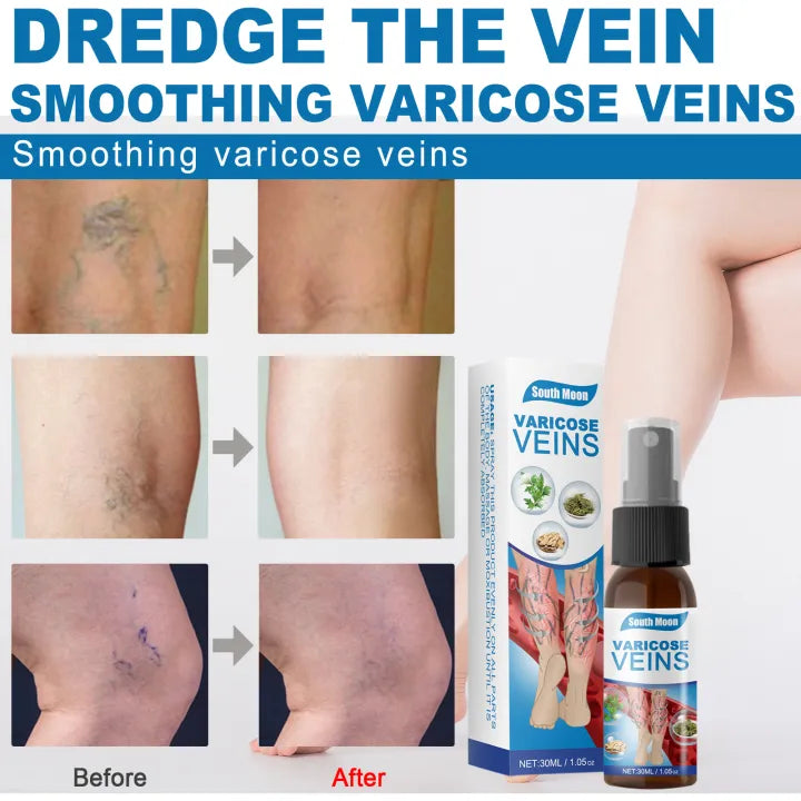 Varicose Veins Relief Spray – South Moon